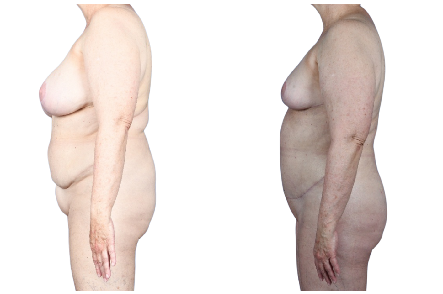 Before and After Image: Extended Breast Reduction, Liposuction 360, Mini Tummy Tuck - left-side