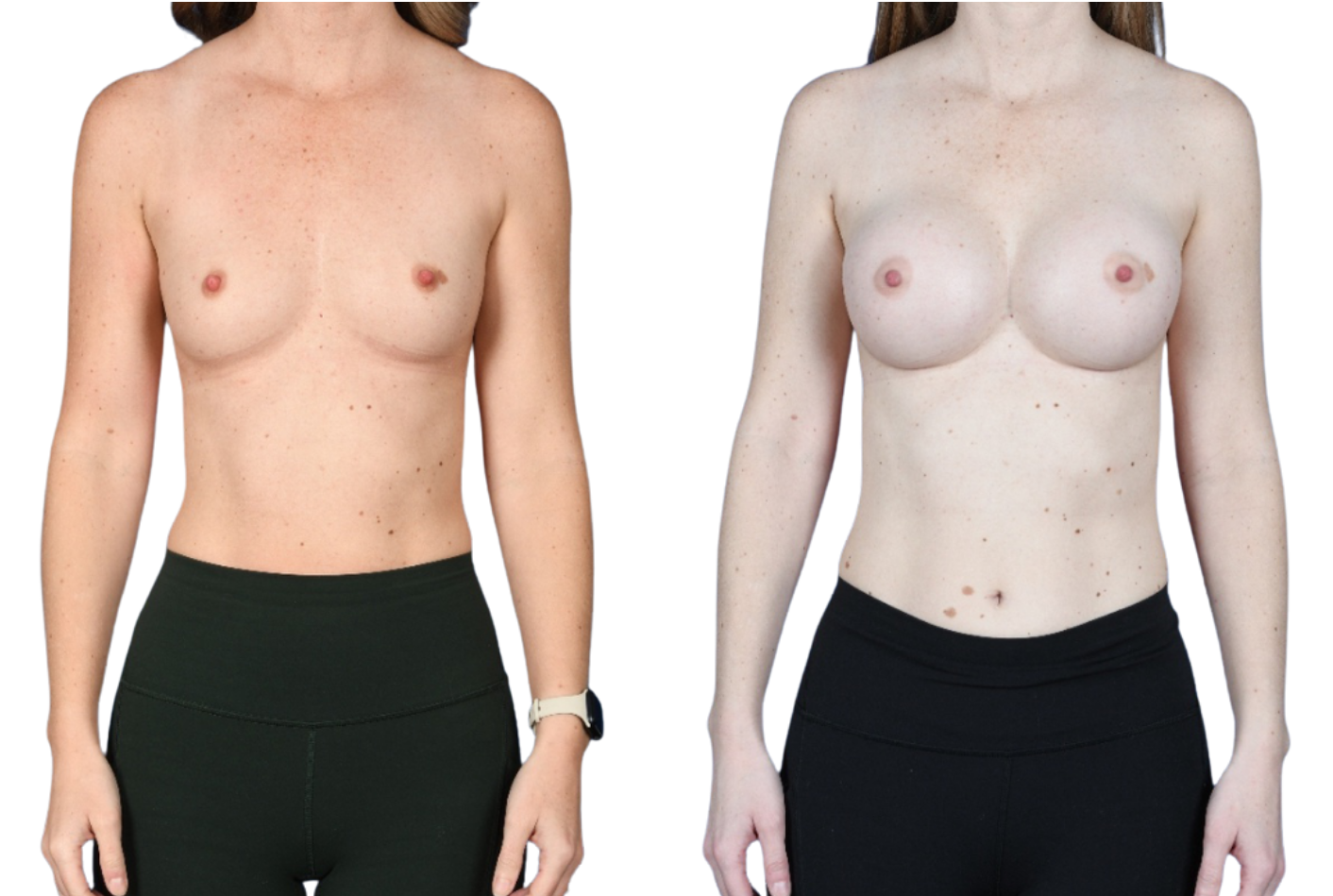 Before and After Image: Breast Augmentation - front