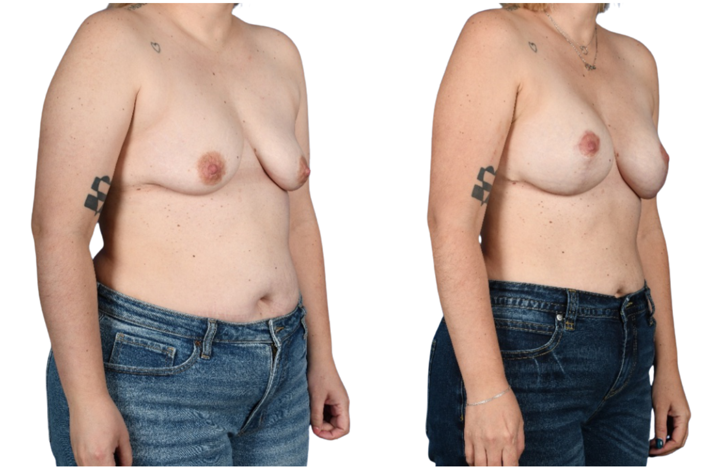 Before and After Image: Mastopexy, Breast Augmentation - right-front-oblique