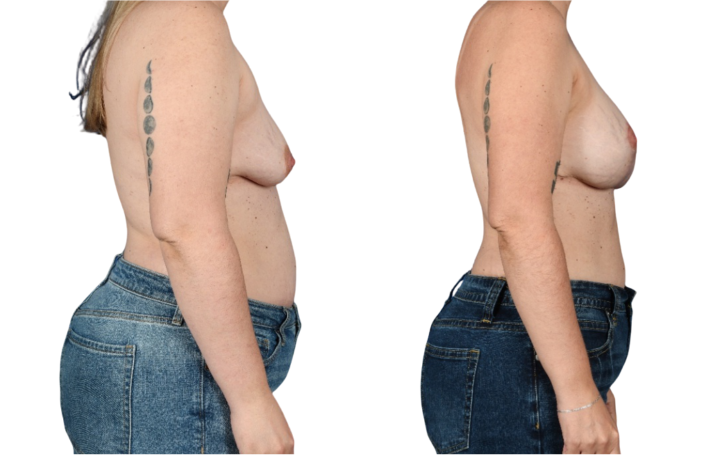 Before and After Image: Mastopexy, Breast Augmentation - right-side