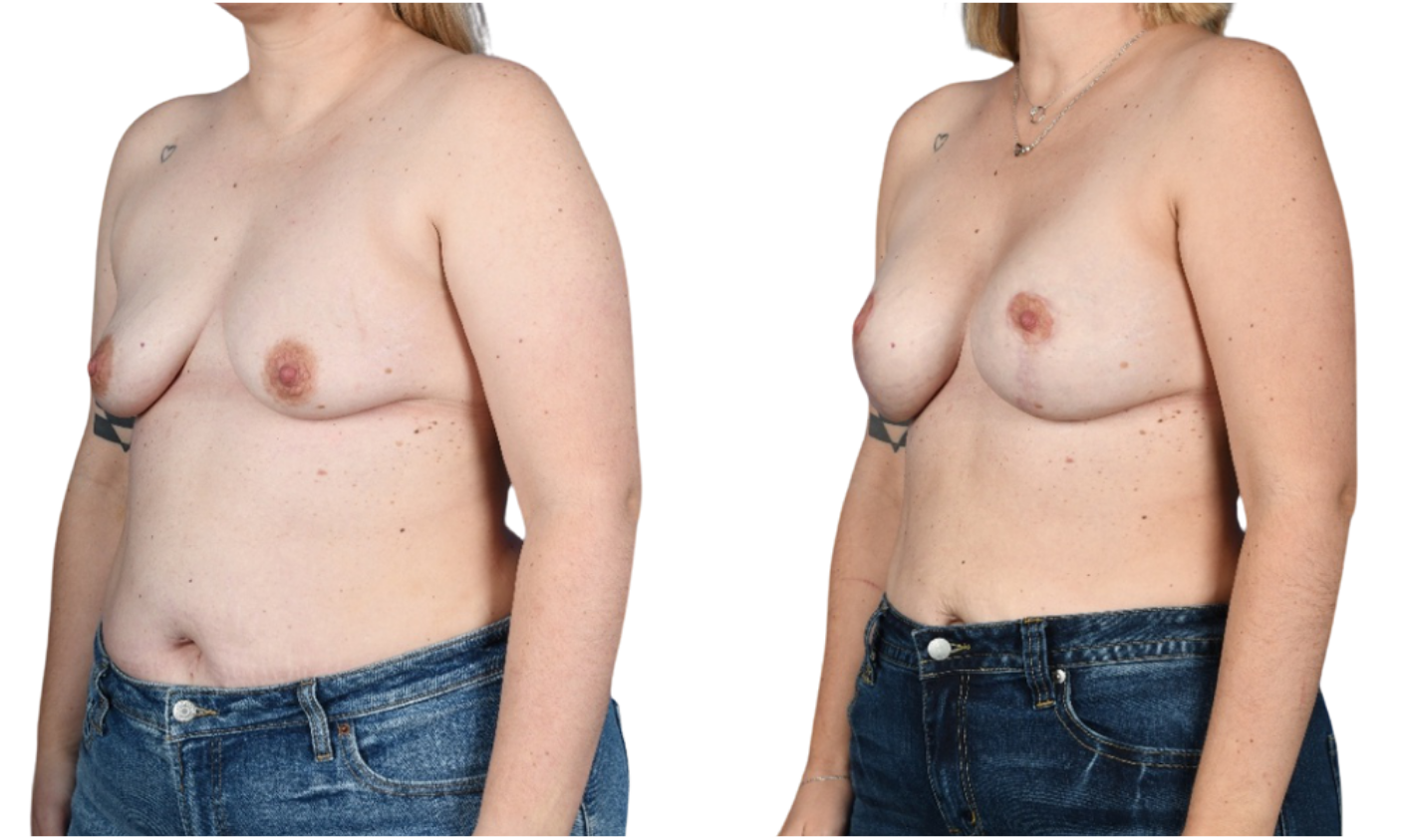 Before and After Image: Mastopexy, Breast Augmentation - left-front-oblique