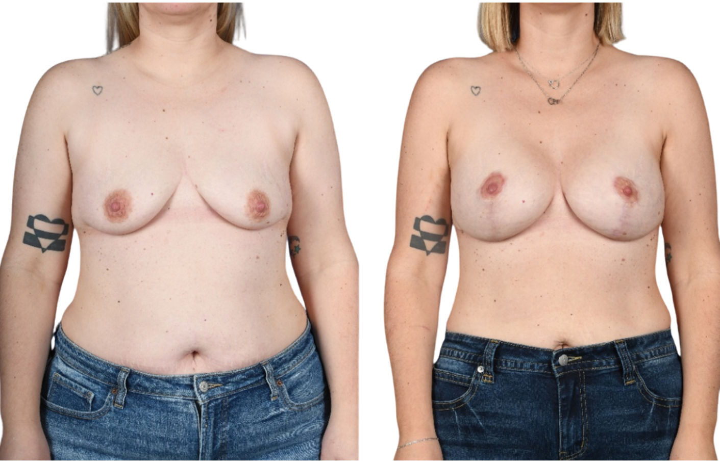 Before and After Image: Mastopexy, Breast Augmentation - front