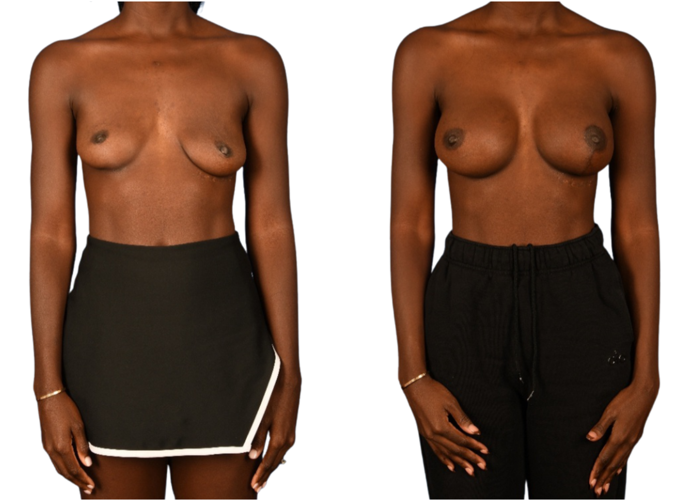 Before and After Image: Left side Mastopexy, Breast Augmentation - front