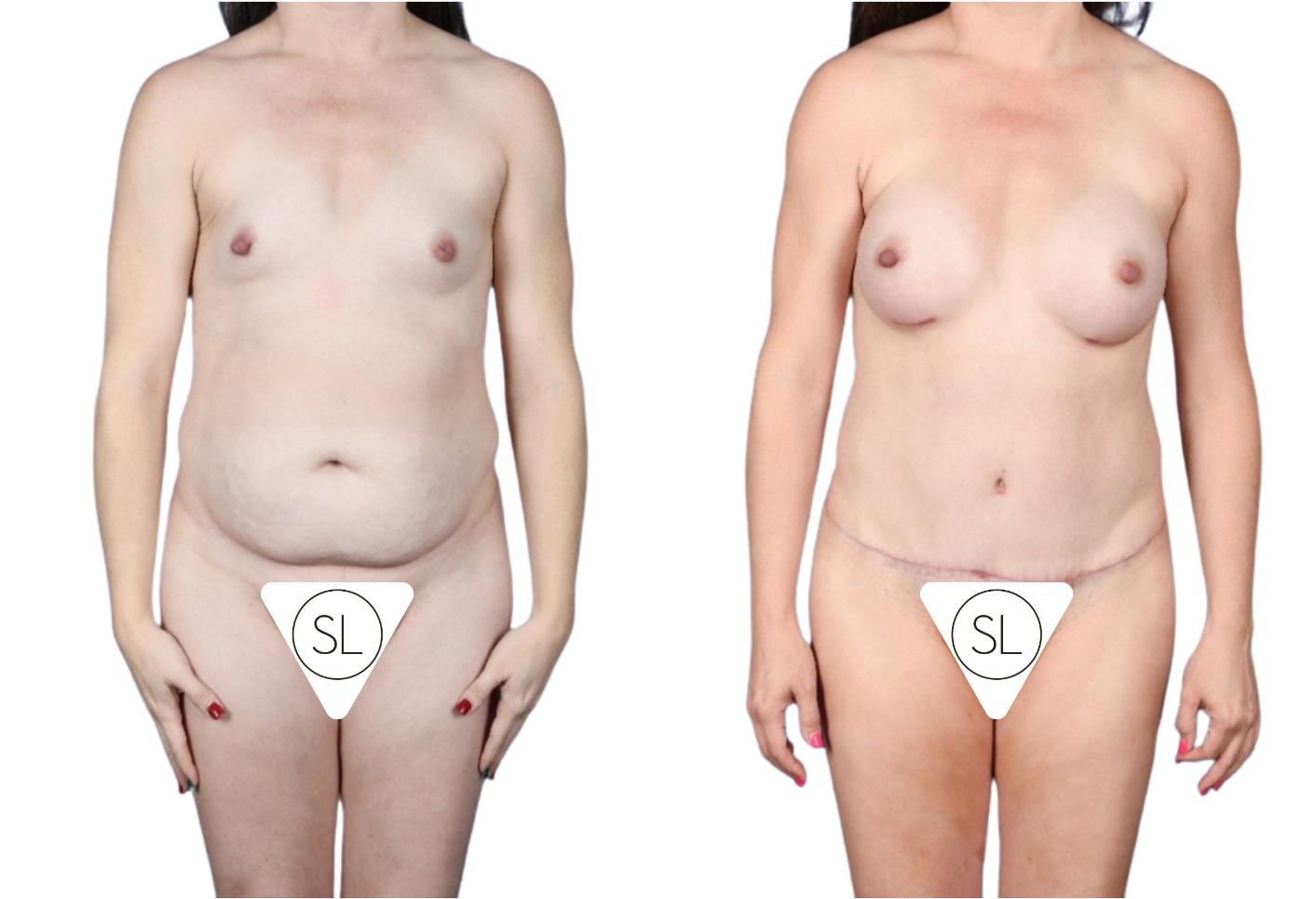 Before and After Image: Standard Abdominoplasty, Breast Augmentation, Left Inverted Nipple Repair - front