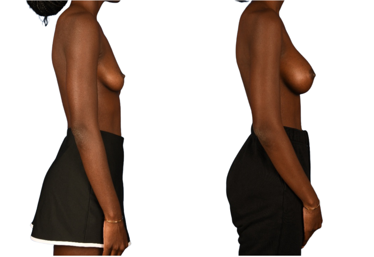 Before and After Image: Left side Mastopexy, Breast Augmentation - right-side
