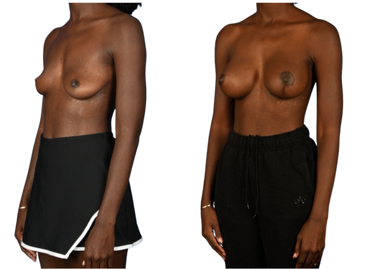 Before and After Image: Left side Mastopexy, Breast Augmentation - left-front-oblique