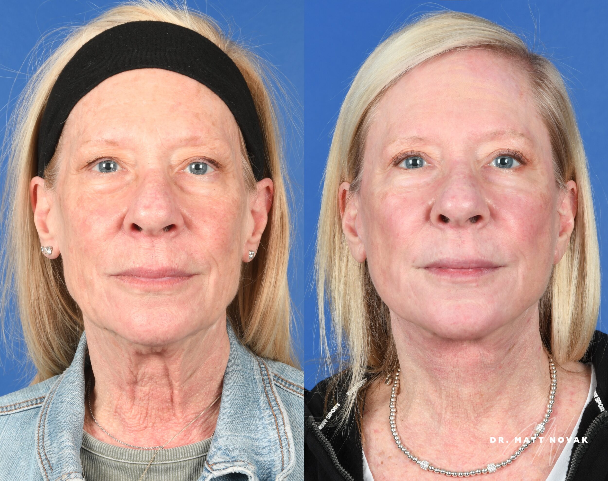 Before and After Image: Facelift, Upper Blepharoplasty, Facial Fat Grafting, Full Face Laser Skin Resurfacing - front