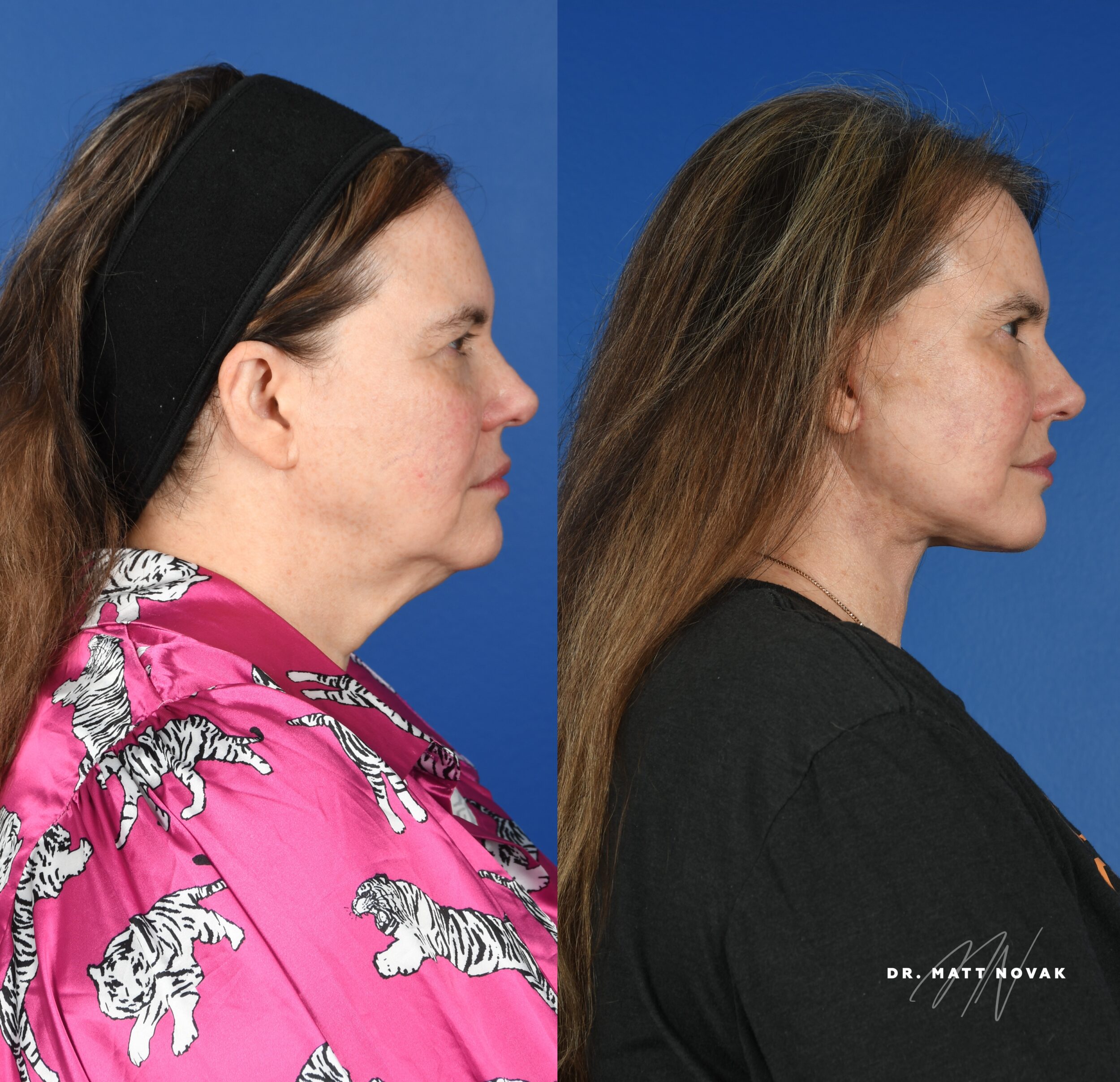 Before and After Image: Facelift - right-side