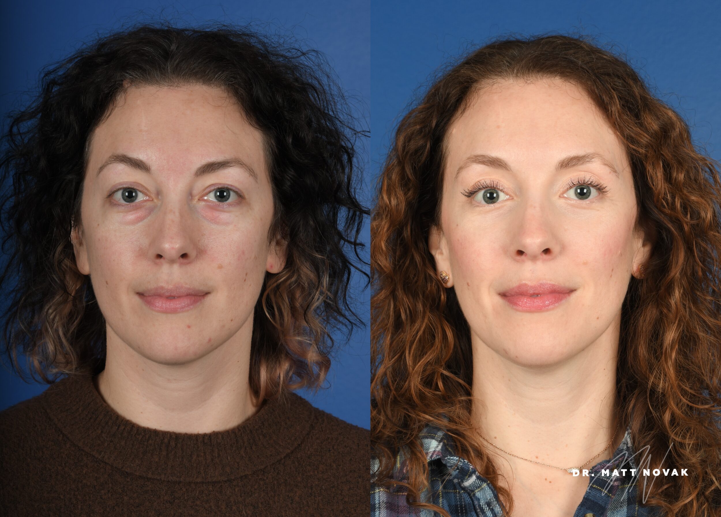 Before and After Image: Upper and Lower Blepharoplasty - front