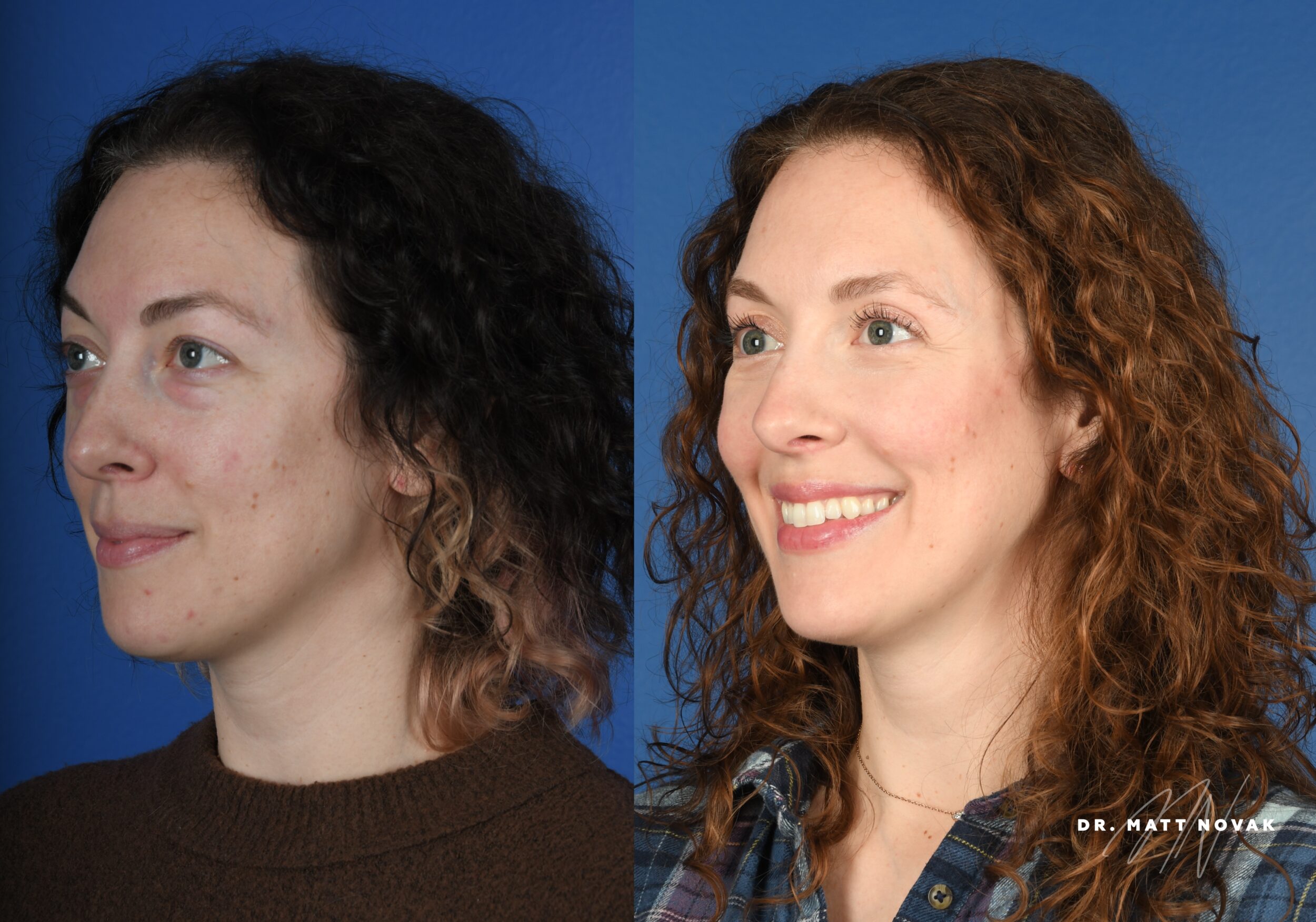 Before and After Image: Upper and Lower Blepharoplasty - left-front-oblique