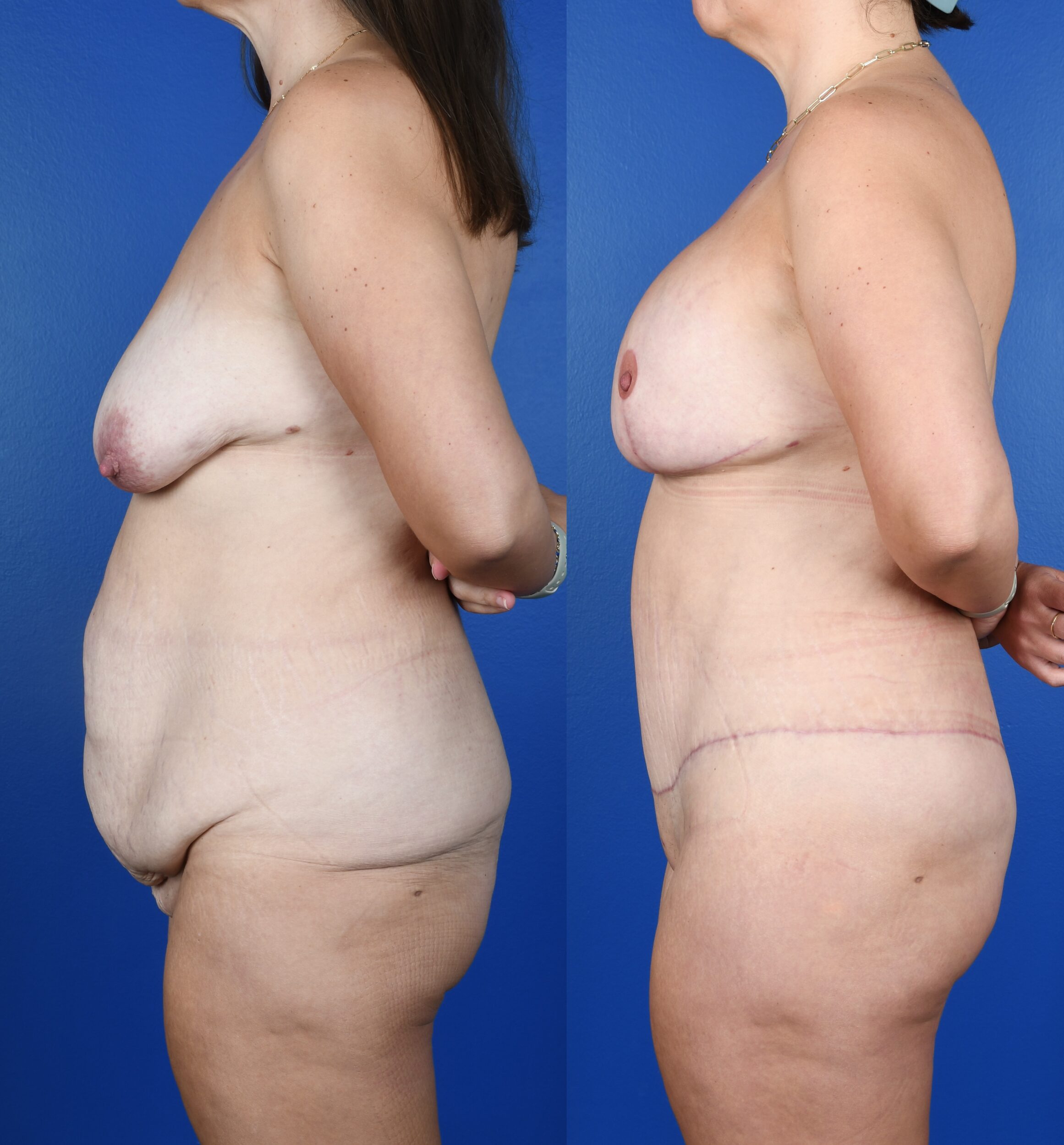 Before and After Image: Extended Abdominoplasty, Breast Augmentation, Mastopexy - left-side