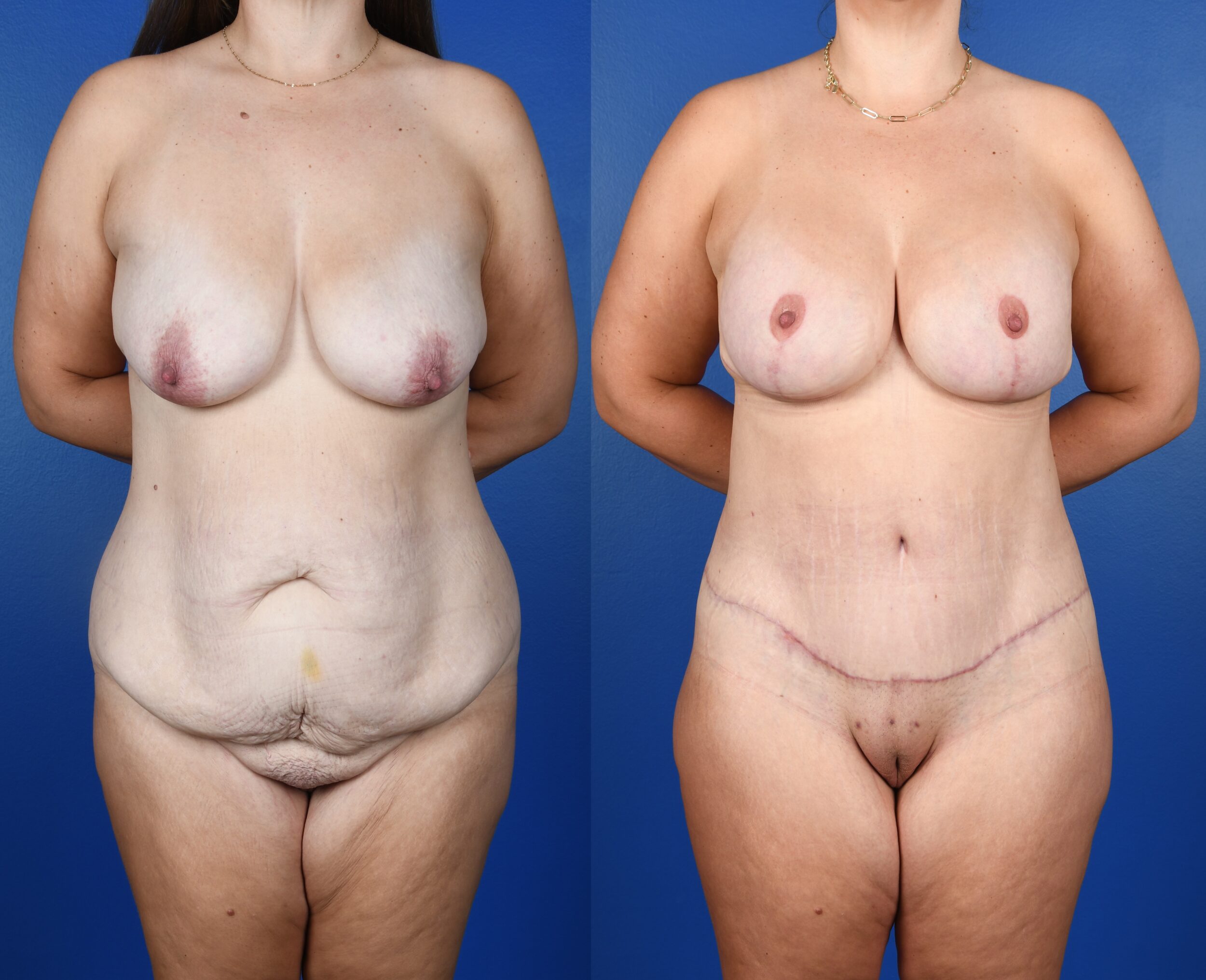 Before and After Image: Extended Abdominoplasty, Breast Augmentation, Mastopexy - front