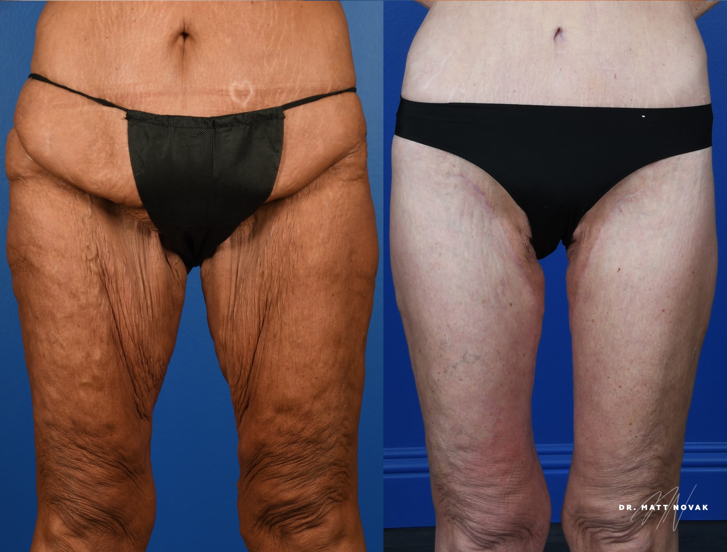 Before and After Image: Brachioplasty, Thigh lift, Circumferential Abdominoplasty - front