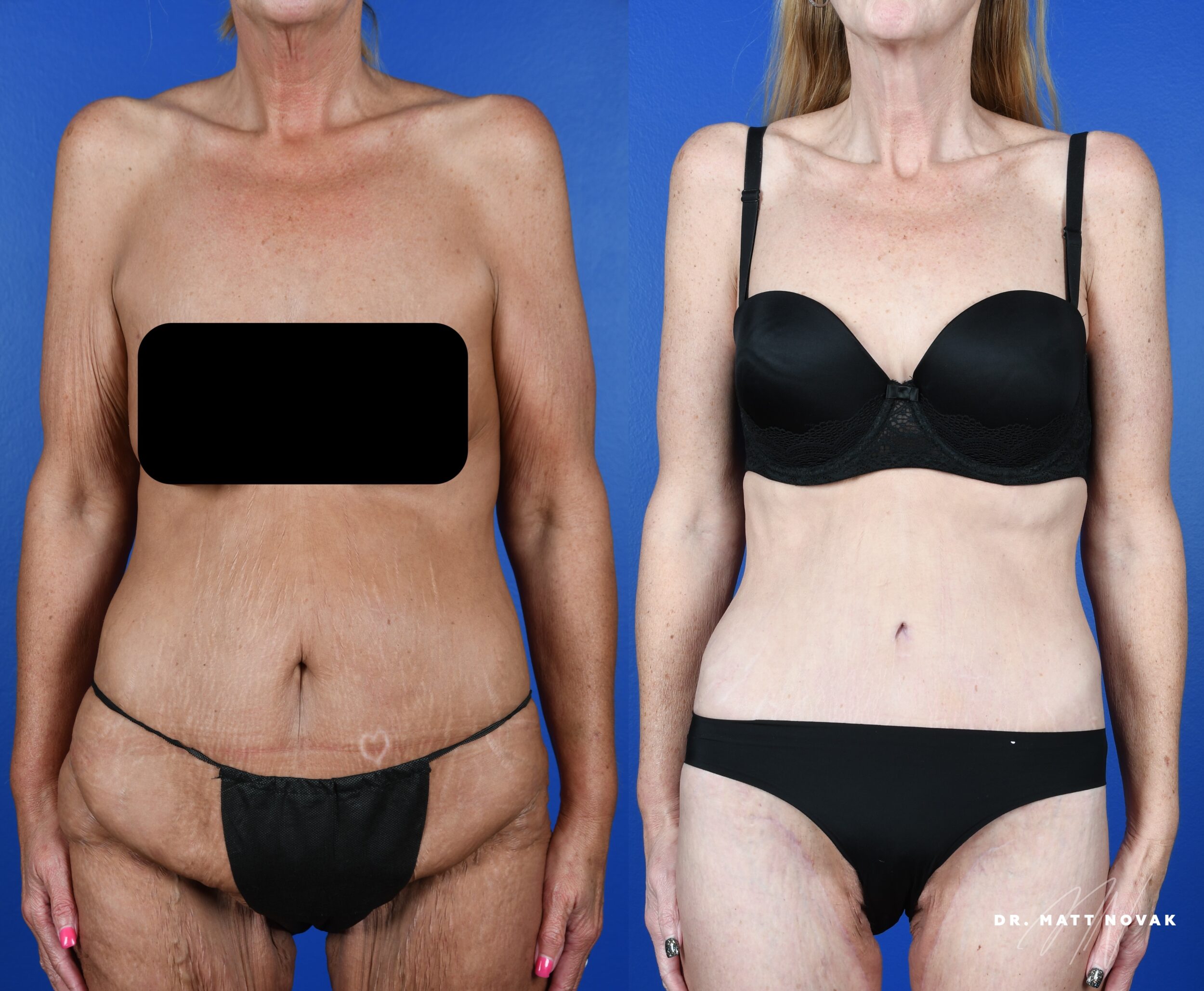 Before and After Image: Brachioplasty, Thigh lift, Circumferential Abdominoplasty - front