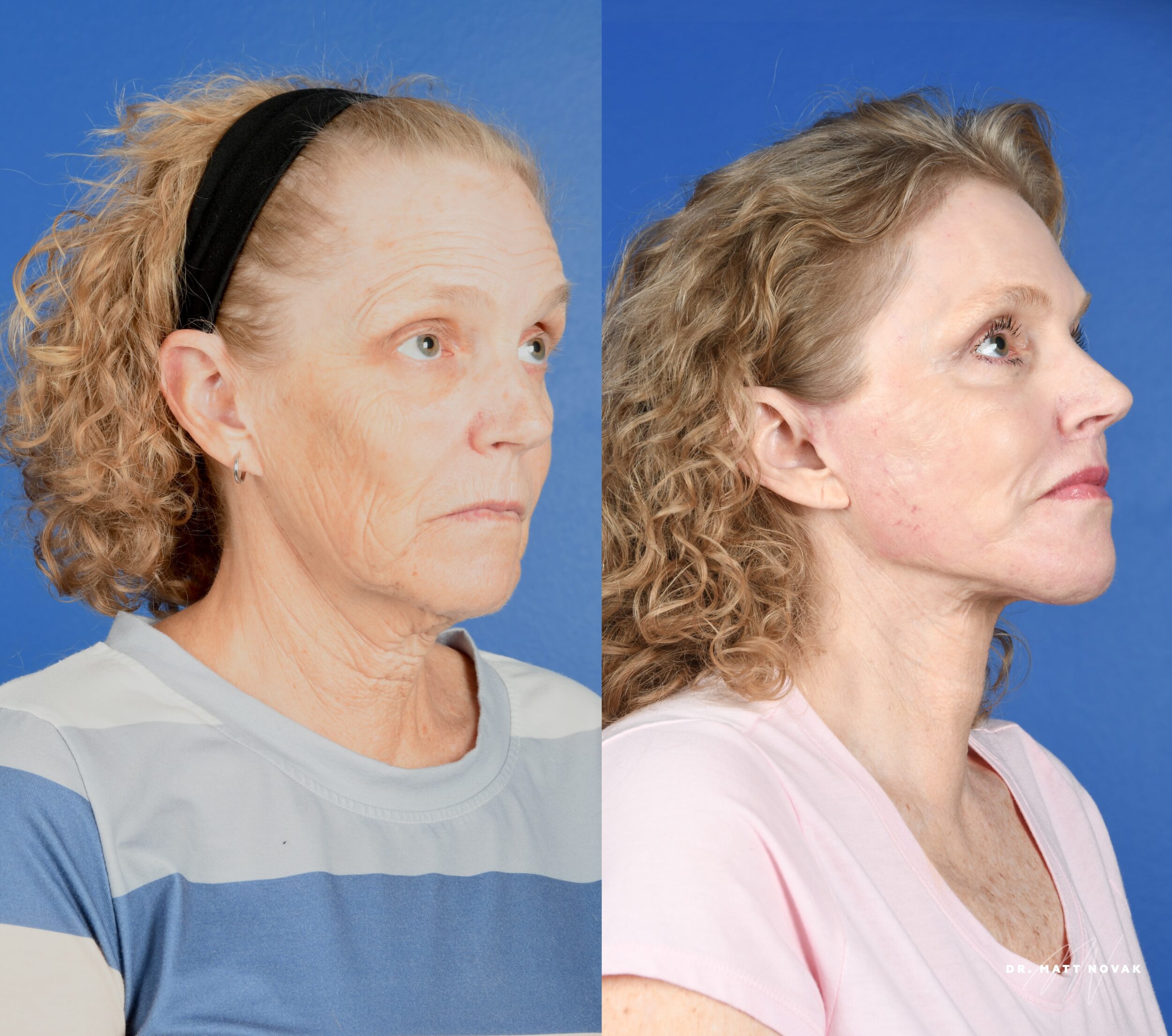 Before and After Image: Facelift, Brow Lift, Upper and Lower Blepharoplasty, Facial Fat Grafting, Lip Lift, Full Face Laser Skin Resurfacing - right-front-oblique