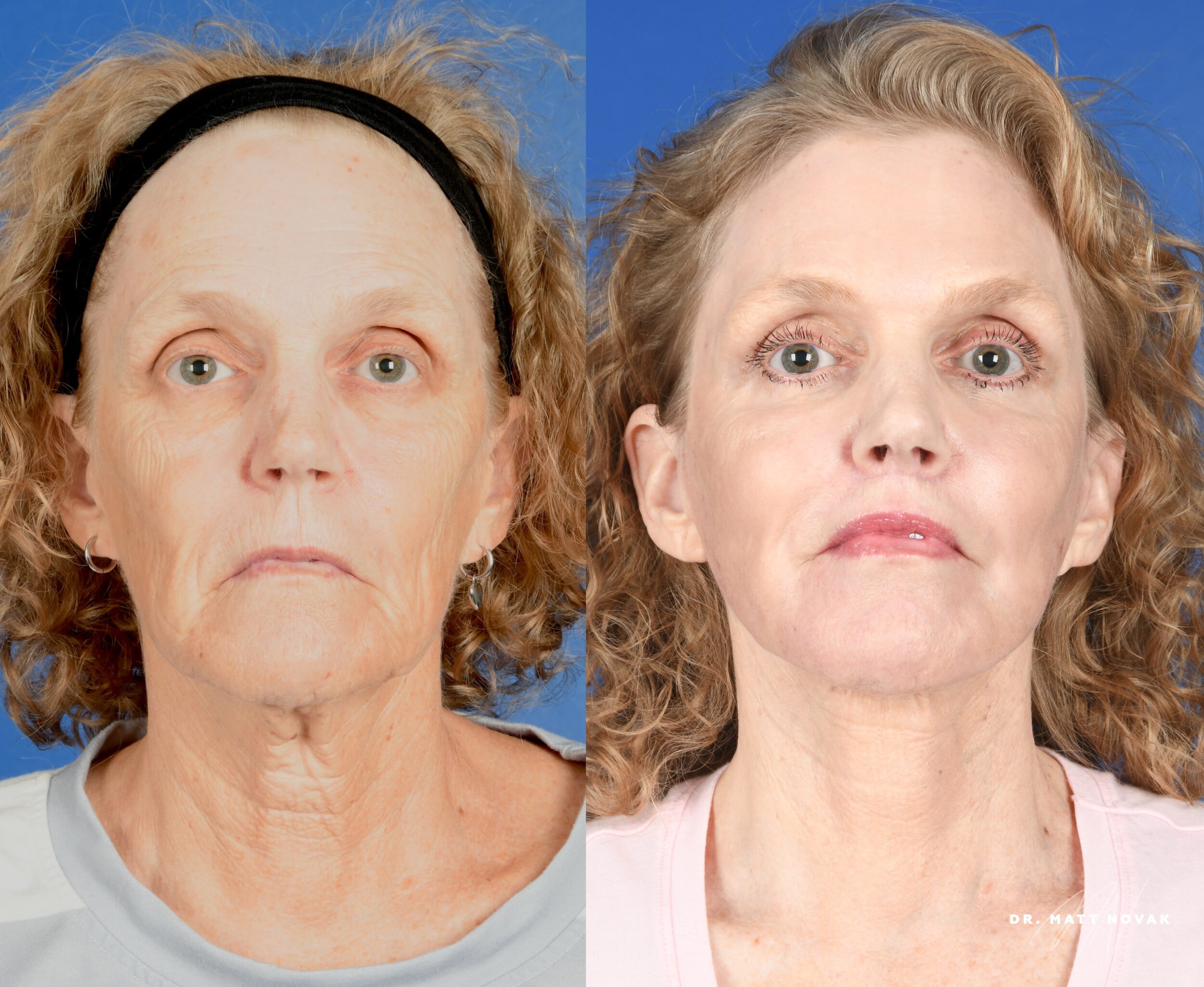 Before and After Image: Facelift, Brow Lift, Upper and Lower Blepharoplasty, Facial Fat Grafting, Lip Lift, Full Face Laser Skin Resurfacing - front
