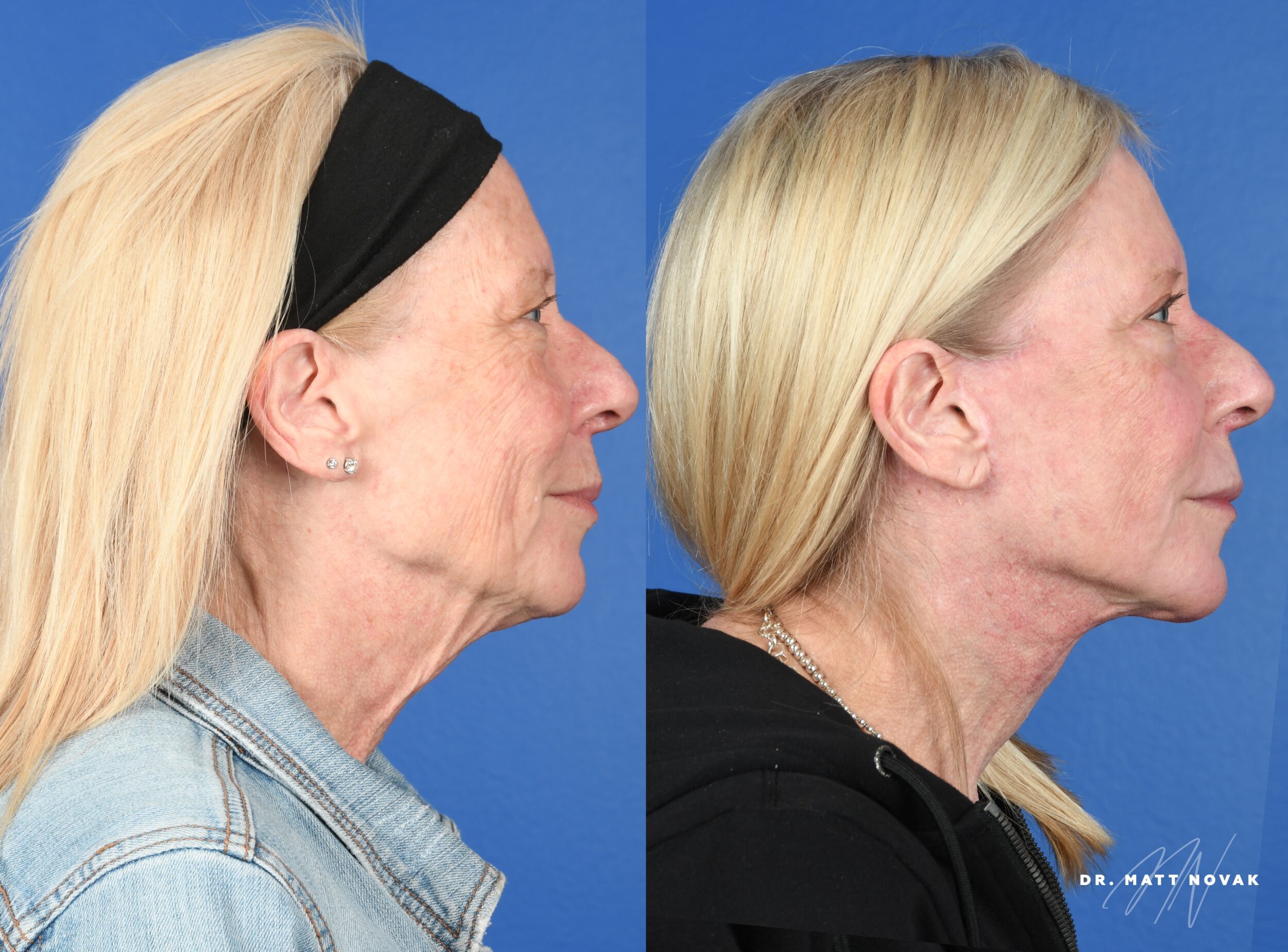 Before and After Image: Facelift, Upper Blepharoplasty, Facial Fat Grafting, Full Face Laser Skin Resurfacing - right-side