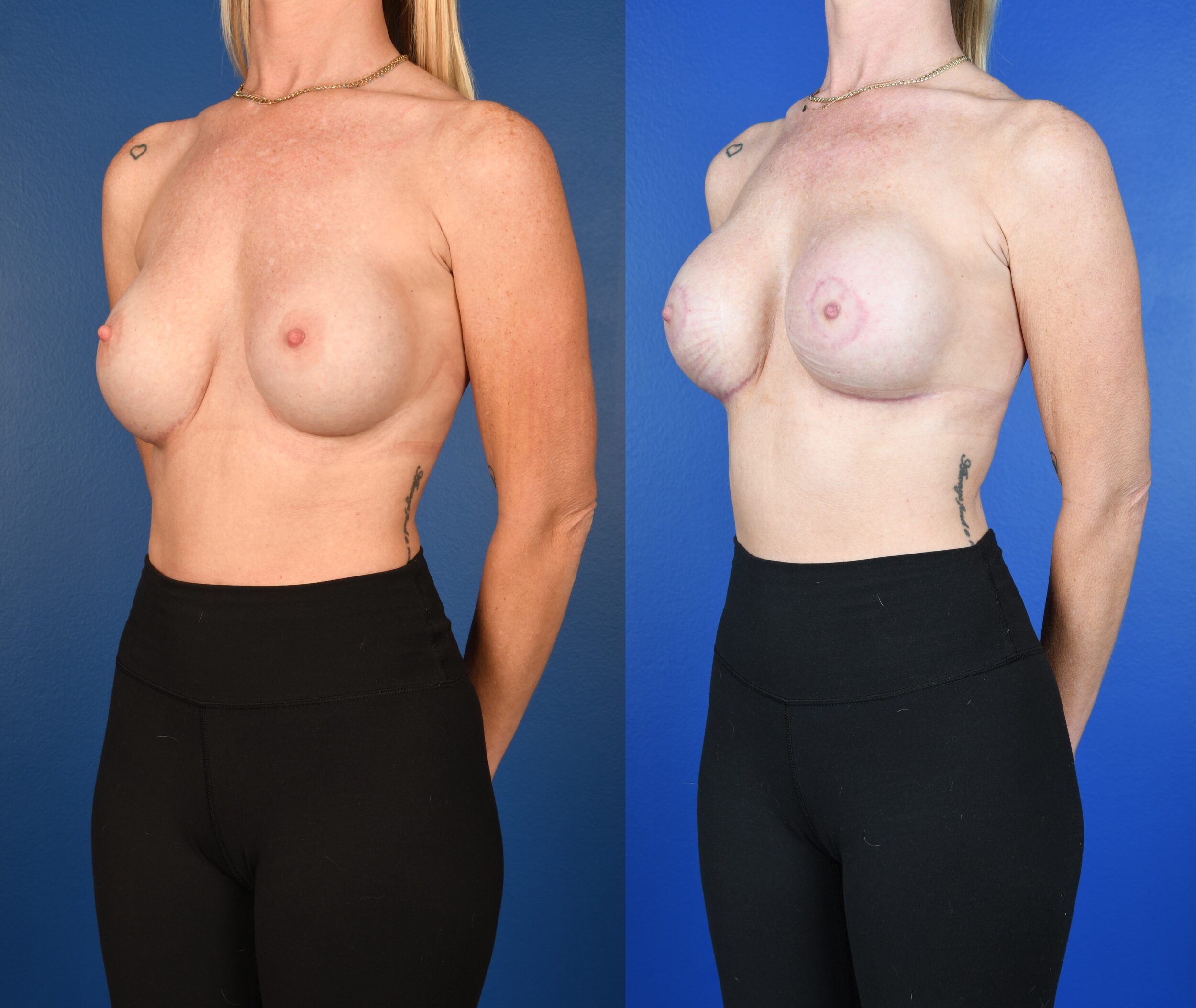 Before and After Image: Breast implant exchange, Periareolar Mastopexy, Mesh Implant Support - left-front-oblique