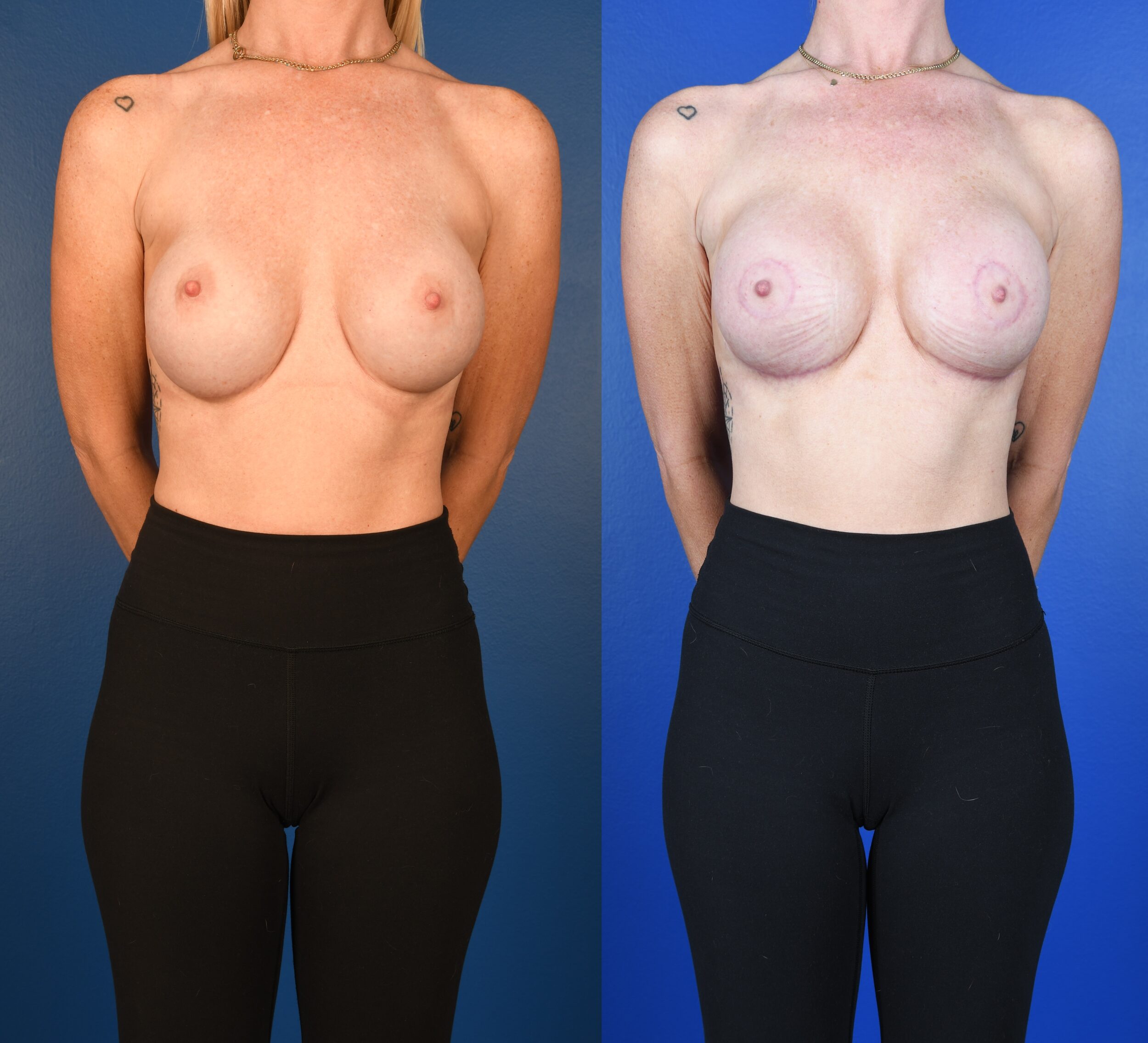 Before and After Image: Breast implant exchange, Periareolar Mastopexy, Mesh Implant Support - front