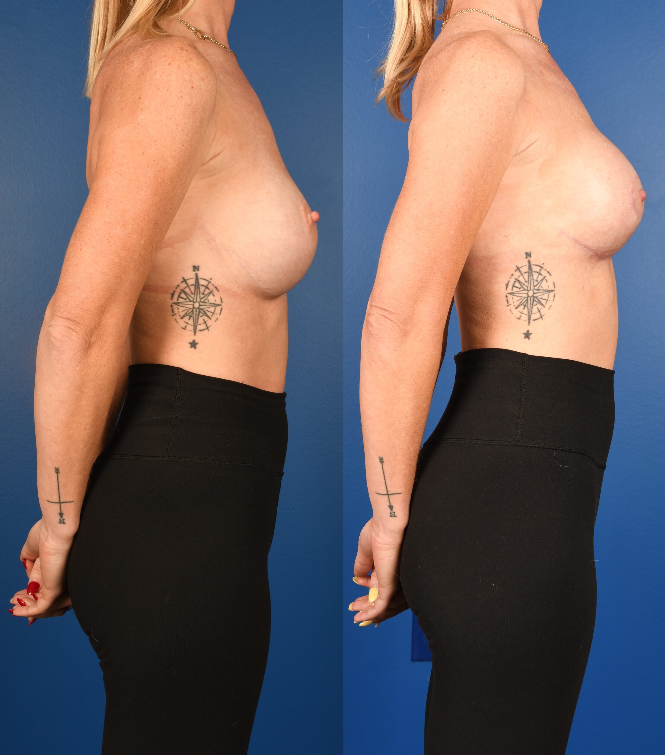 Before and After Image: Breast implant exchange, Periareolar Mastopexy, Mesh Implant Support - right-side