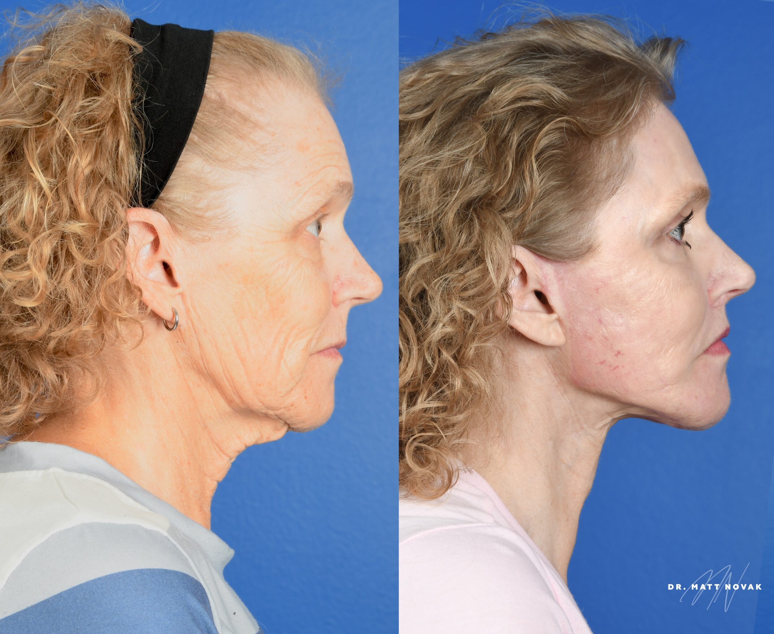 Before and After Image: Facelift, Brow Lift, Upper and Lower Blepharoplasty, Facial Fat Grafting, Lip Lift, Full Face Laser Skin Resurfacing - right-side