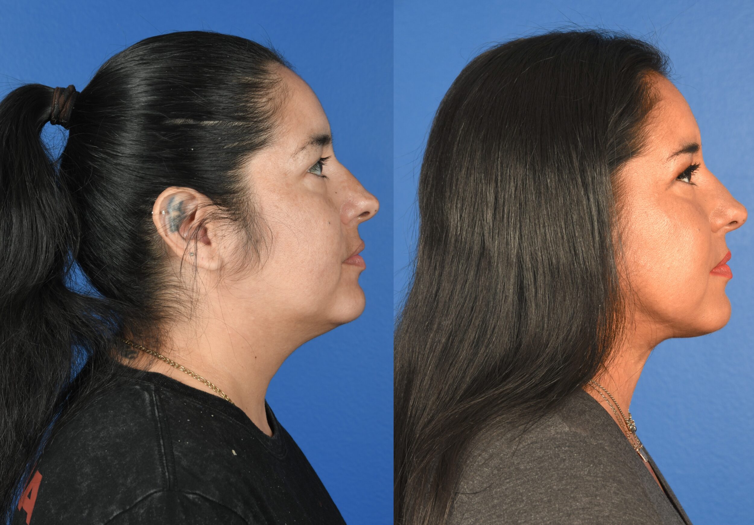 Before and After Image: Jawline Liposuction - right-side