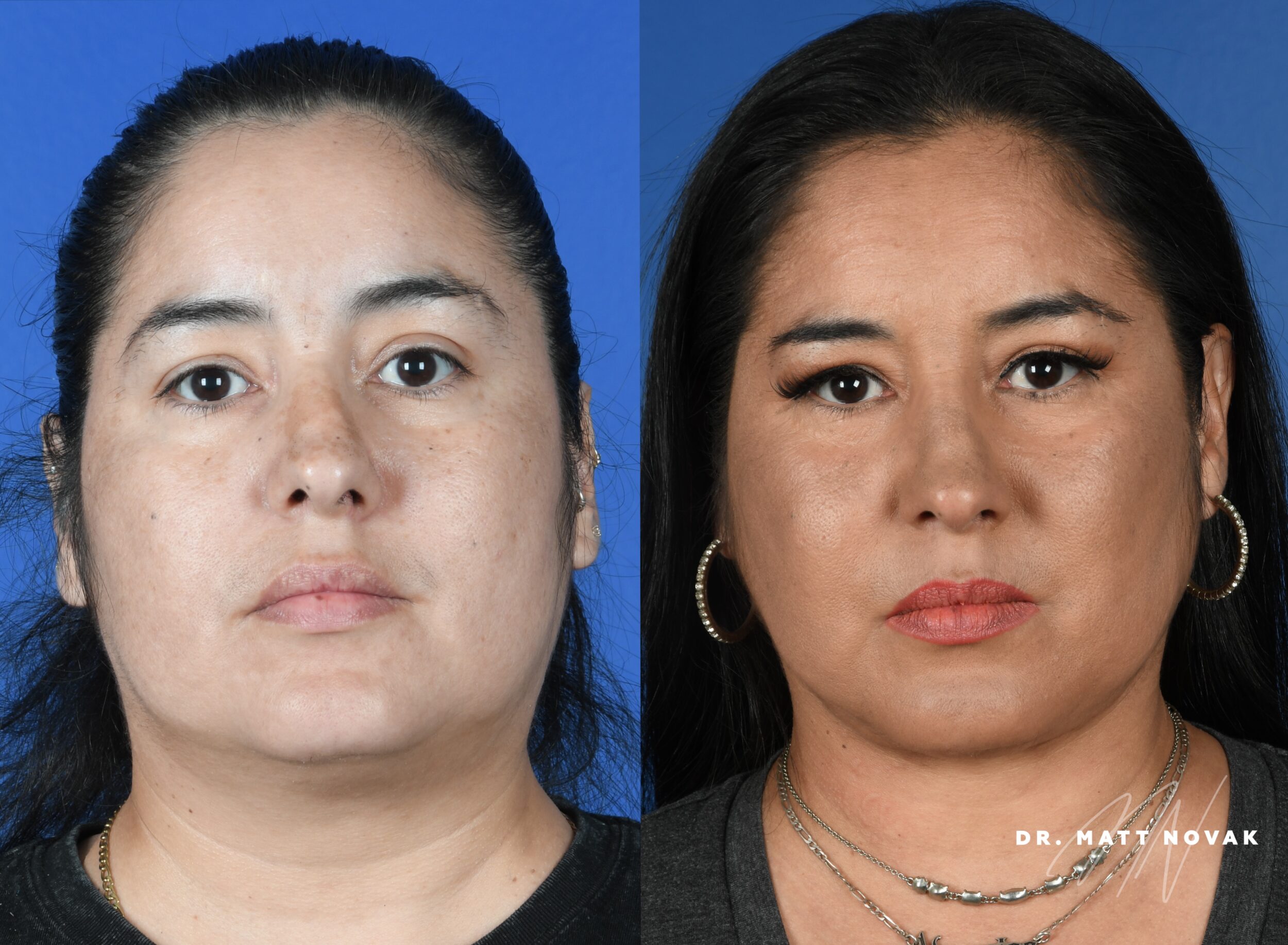 Before and After Image: Jawline Liposuction - front