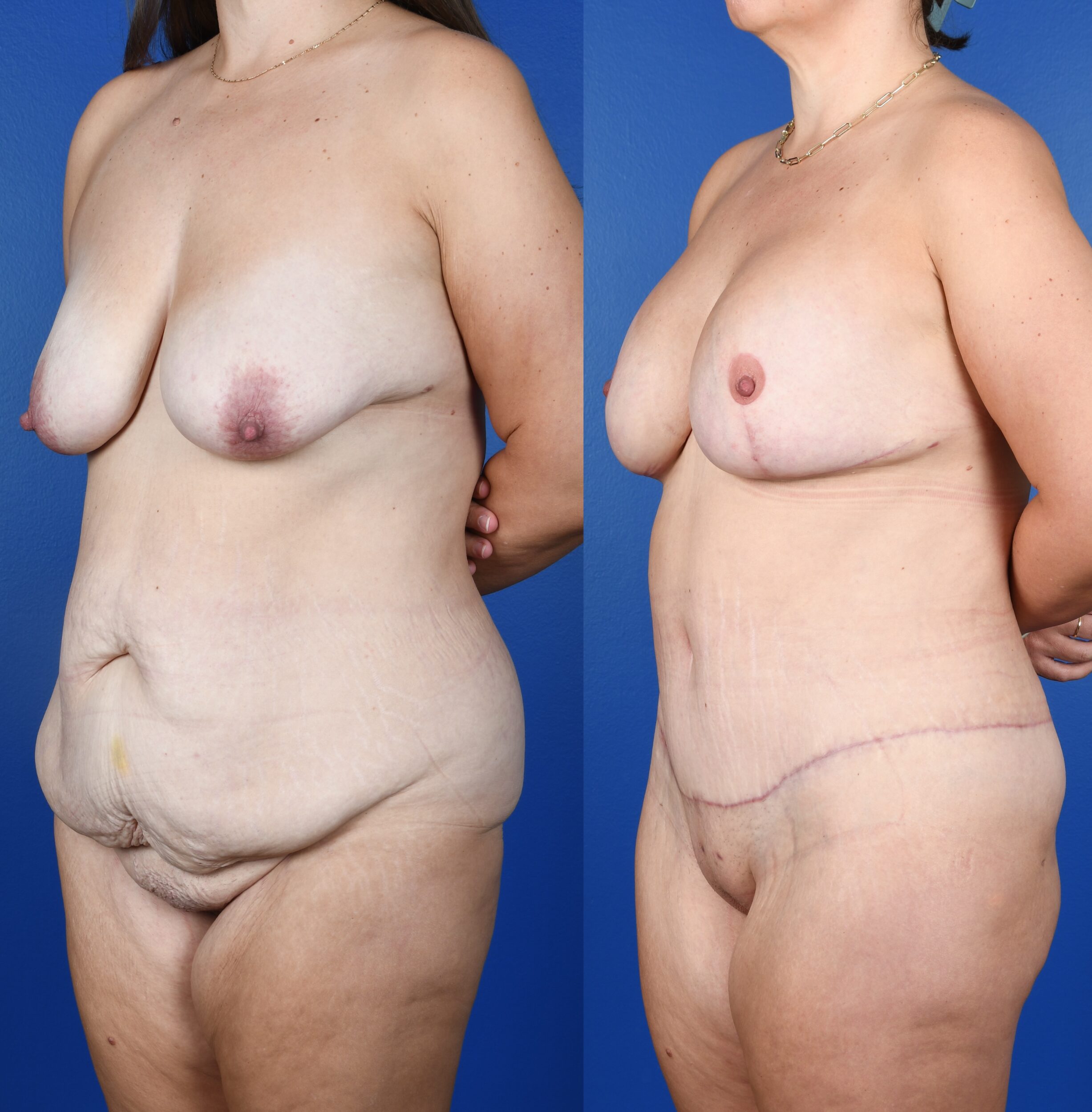 Before and After Image: Extended Abdominoplasty, Breast Augmentation, Mastopexy - left-front-oblique