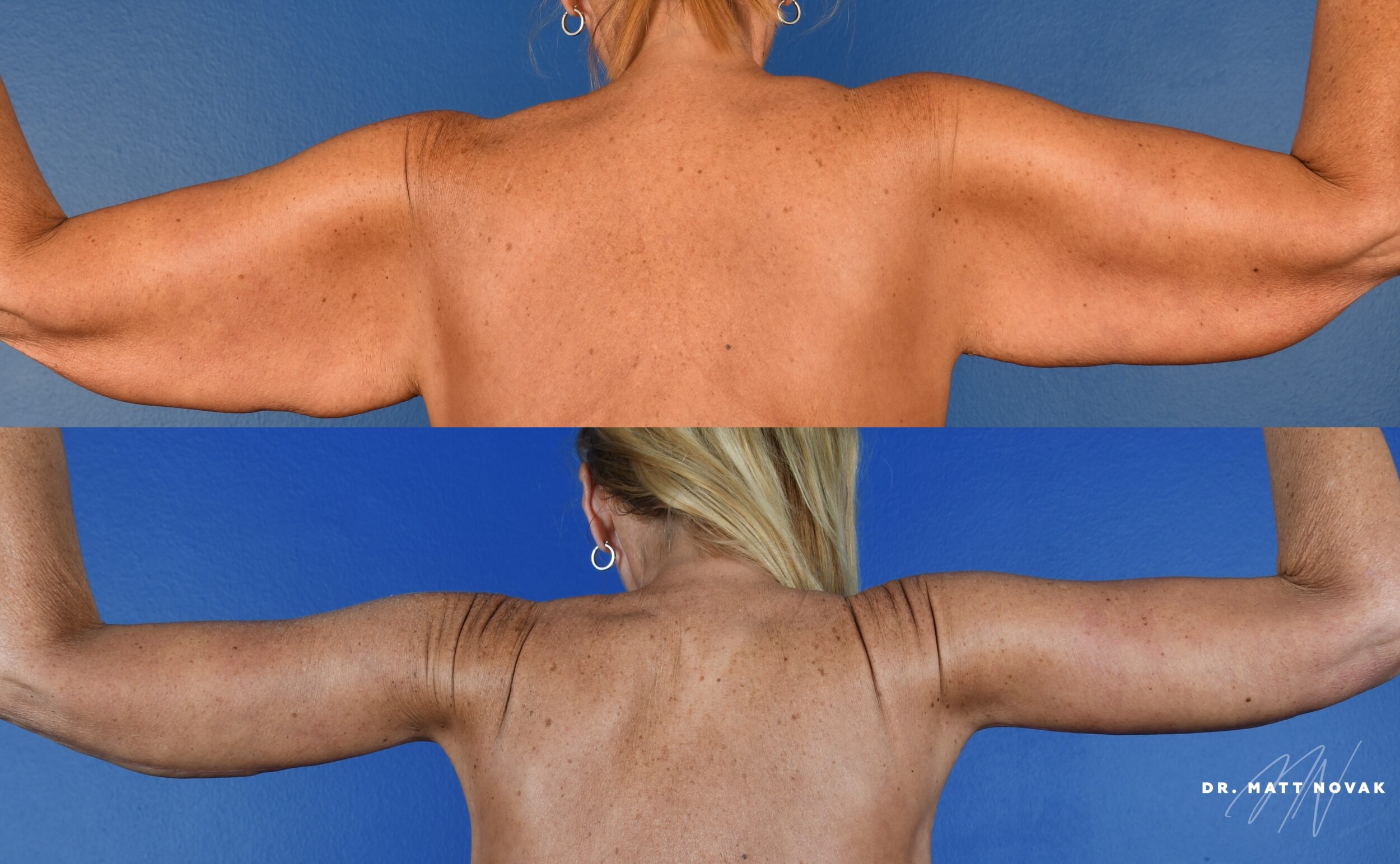 Before and After Image: Brachioplasty, Thigh lift, Circumferential Abdominoplasty - back