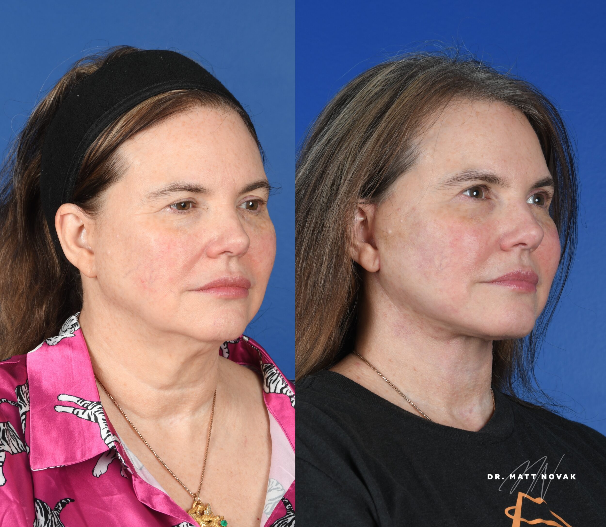 Before and After Image: Facelift - right-front-oblique