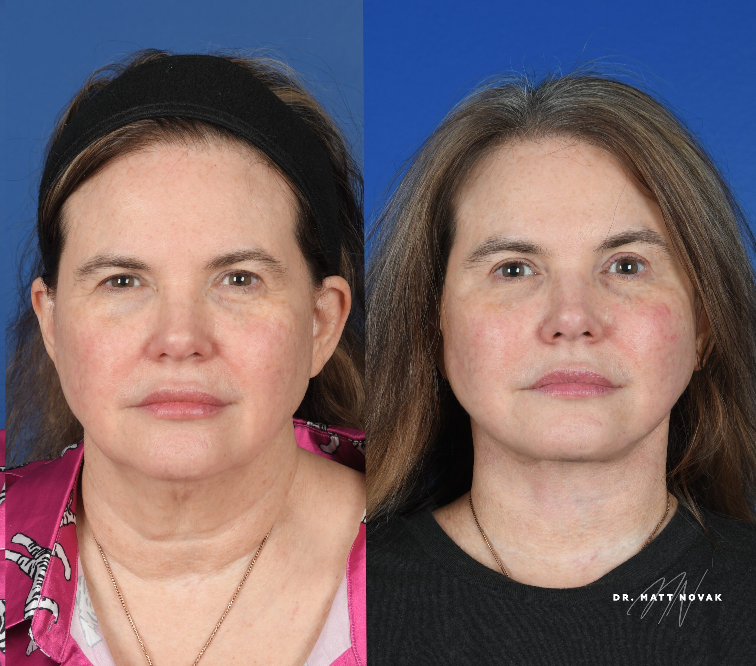 Before and After Image: Facelift - front