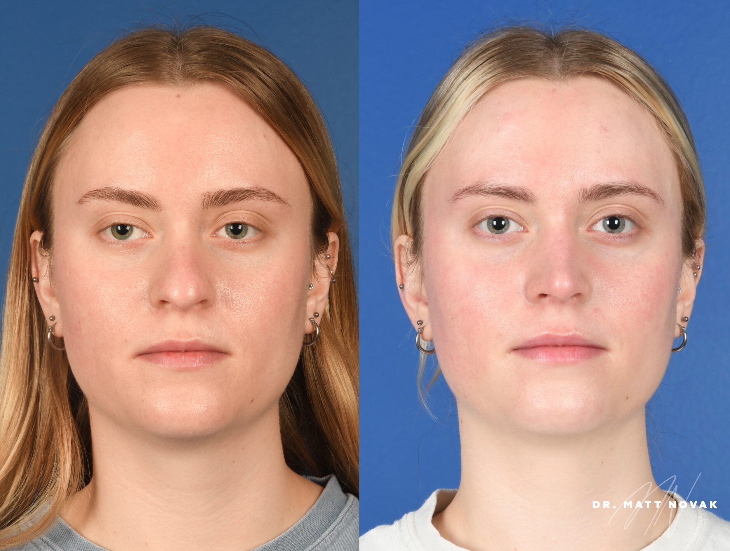 Before and After Image: Rhinoplasty - front