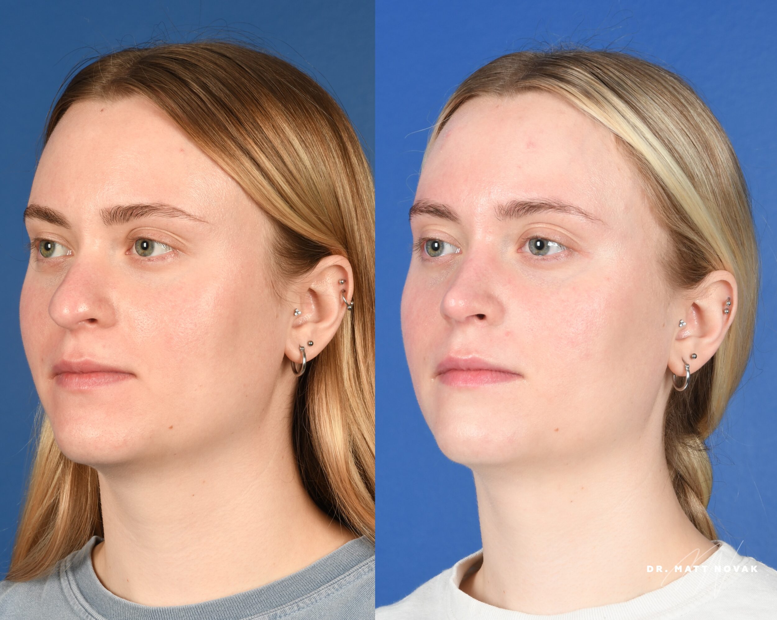Before and After Image: Rhinoplasty - left-front-oblique