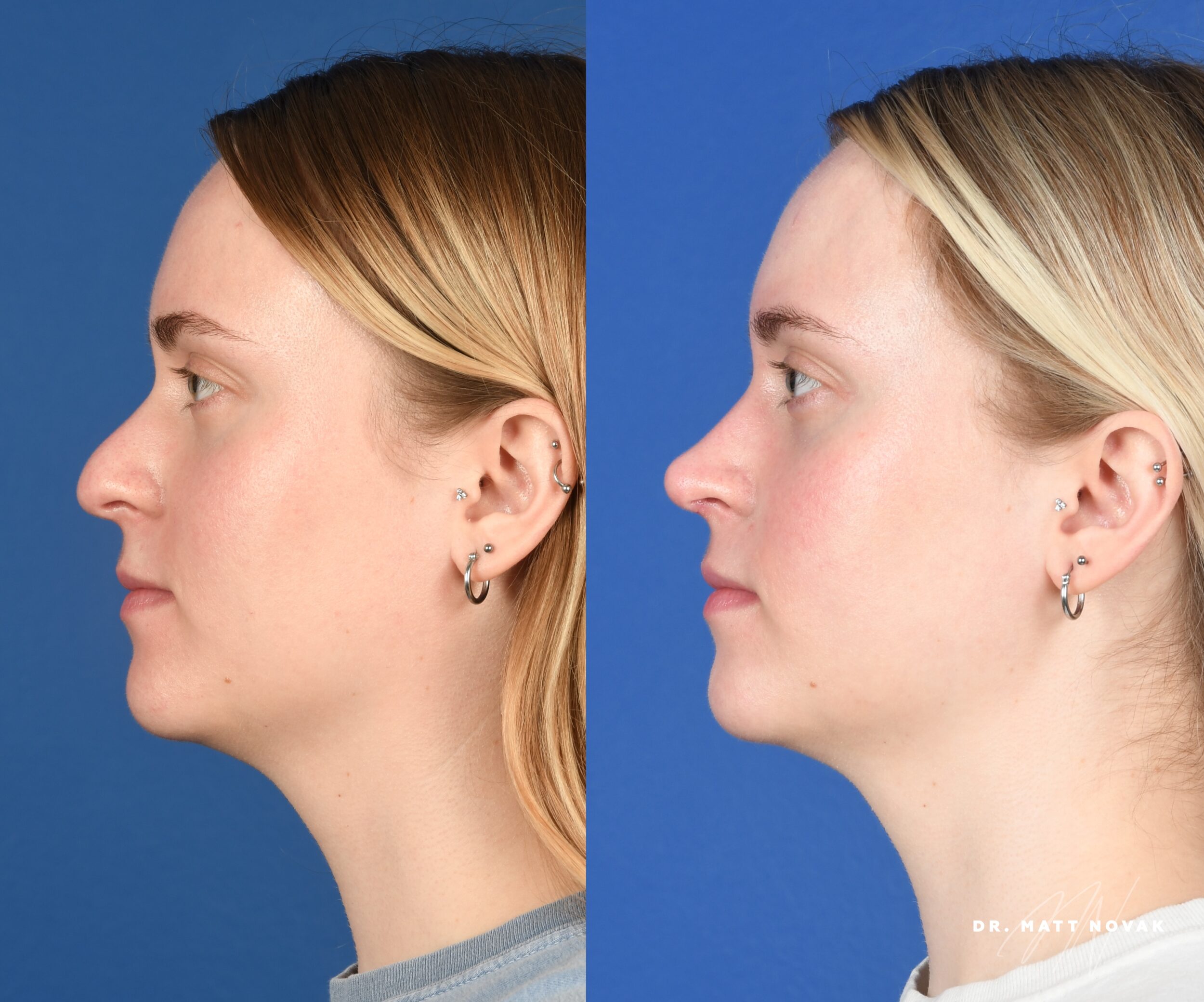 Before and After Image: Rhinoplasty - left-side